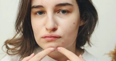 أطعمة تحارب حب الشباب وندباته: دليل غذائي للتخلص من البشرة الدهنية