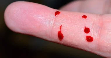 مراهقة روسيّة في المستشفى: هل شرب الدم علاج فقر الدم أم وصفة للموت؟