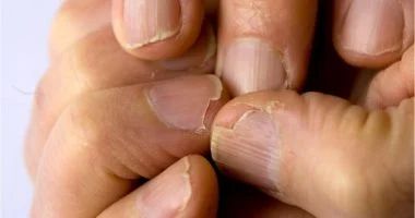 نقص الحديد يهدد جمالك: هكذا تكشف بشرتك وأظافركِ عن المشكلة