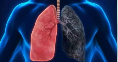 السرطان ينتصر جزئيًا: 70% نسبة التعافي عالميًا.. والأبحاث مستمرة لإنهاء المعركة