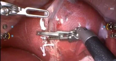 جراحة روبوتية بالكامل: الصين تنجح في إزالة ورم من خنزير دون تدخل بشري [روبوت صيني]