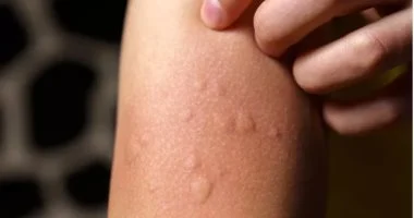 حكة لا تتوقف: أطباء يحذرون من 4 أنواع سرطان قد تكون السبب الخفي